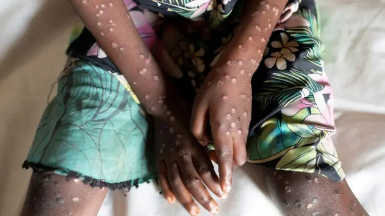 Kenya report  first death  Mpox , positive cases rise to 13 .